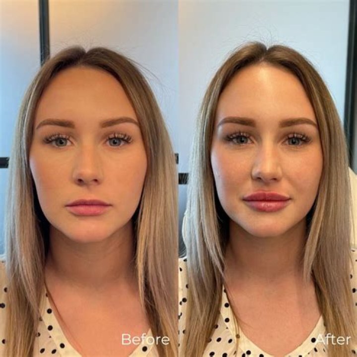 Brielle Biermann Fans Can’t Get Over How Beautiful She Looks In New Pics After Dissolving Her Dramatic Lip Fillers!
