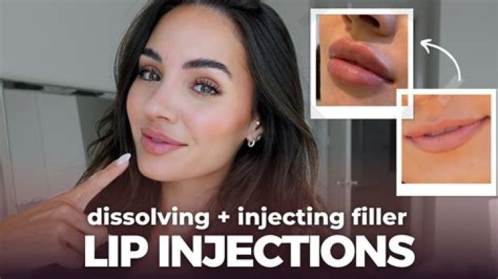 Did Sofia Richie Get Lip Injections?